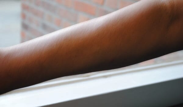 Het bleken van de huid Het bleken van de huid