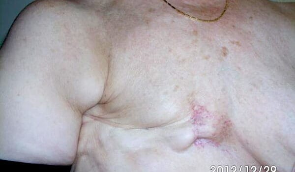 Borsten en borstkanker bij een vrouw